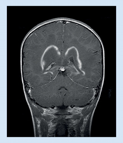 Figure 4. MRI in X-linked adrenoleukodystrophy.Contrast enhancement around a bilateral zone of white matter.