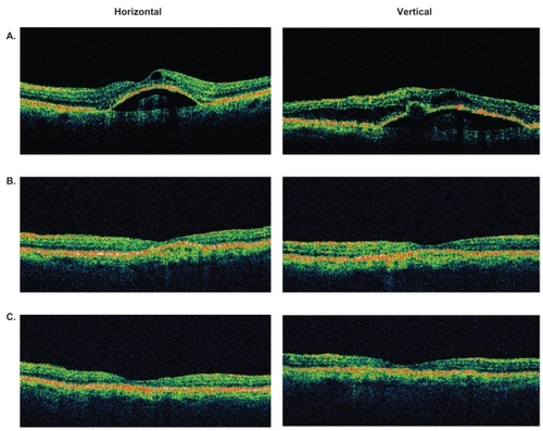 Figure 4 Representative optical coherence tomography (OCT) images of an eye with retinal angiomatous proliferation that had resolution of macular and subretinal pigment epithelial fluid at 4 weeks and maintained a dry macula at 8 weeks after a single intravitreal bevacizumab injection. A) Baseline OCT images through central macula. B) OCT images at 4 weeks. C) OCT images at 8 weeks.