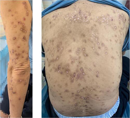 Figure 3 W10 (prurigo nodularis improved after acupuncture therapy at week 10).