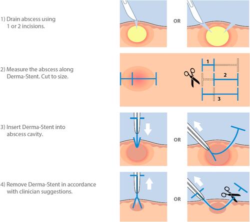 Figure 1 Schematic illustration of the Derma-Stent device and various configurations for deployment in the abscess cavity.