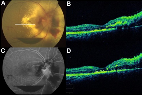 Figure 55 (A and C) Color fundus photograph and fluorescein angiogram of the right eye demonstrate papilledema, subhyaloid and retinal hemorrhages, and extensive peripapillary lipid exudation in the posterior pole, secondary to radiation retinopathy. (B and D) Spectral domain optical Cirrus™ coherence tomography image of the same eye, with noticeably increased nasal retinal thickness and hard exudates in the inner nuclear layer, outer plexiform layer, and outer nuclear layer.