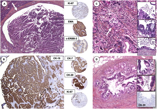 Figure 2. Histomorphological findings of an IPMN. (A) The IPMN is shown in the main pancreatic duct (arrow), with (B) positive staining for epithelial marker cytokeratin (CK)-19. Encircled area resembles the area for the immunohistochemistry markers to the right (middle column). (C) Part with invasive pancreatic adenocarcinoma and high-grade dysplasia in the pancreatic resection margin (inlets). (D) Areas of Pancreatic Intraepithelial Neoplasia (PanIN), with loss of cytokeratin-20, an epithelial marker. Presented to the annual meeting of the Norwegian Society of Pathology (Bergen, December 2004).