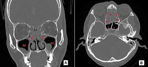 Figure 1 Radiological measurement using Lund Mackay score system for CTPNS axial (A) and coronal (B) sections, for example (A) the right maxillary sinus was scored as 1, left maxillary sinus as 1 and both ostiomeatal complexes as 2 each and (B) the anterior and posterior ethmoidal air cells on both sides were scored as 2 each and both sphenoid air cells as 0 each.