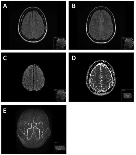 Figure 1. (A–E) Axial FLAIR (A and B) demonstrate at time of the acute onset scattered hyperintensive lesions in the white matter of centrum semiovale and subcortically in both hemispheres. Some of these lesions demonstrated reduced diffusion on DWI (C) and ADC (D) maps suggestive of acute small ischemic events. The 3DToF (Time-of-Flight) MR angiography (E) of the intracranial vessels demonstrated normal vessels without evidence of vasculitis or stenosis.