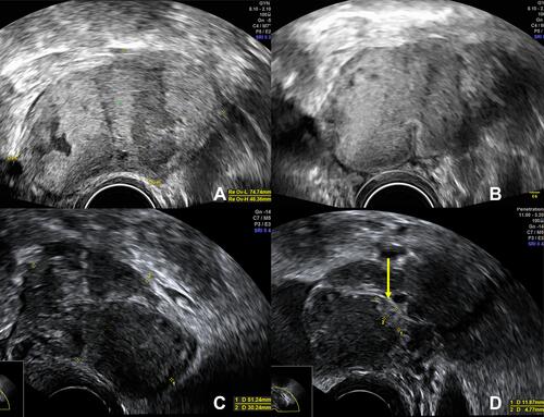 Figure 2 Sonographic findings of 11/2018: (A and B) large, septated cystic lesion with mostly ground glass echogenic content and signs of fresh hemorrhages in the right ovary; (C and D) left ovary with endometrioma-like cystic lesions with ground glass echogenic content with a possible papillary structure in one of them (yellow arrow).