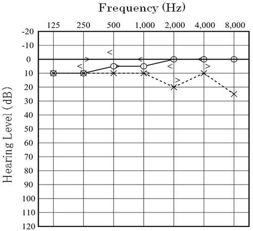 Figure 1. Audiogram on the first visit.