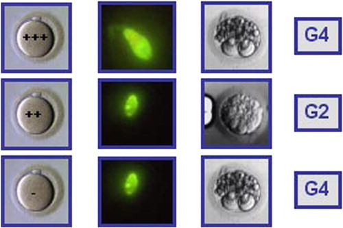 Figure 2 Hypothetical case of an IVF cycle where three oocytes were microinjected with spermatozoa from a semen sample with a DNA fragmentation value of 50%, measured by TUNEL and flow cytometry. All embryos were of low quality (G4, G2, and G4). All three embryos were transferred and no pregnancy ensued.