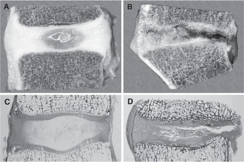 Figure 1 Degenerative changes of the intervertebral disc. Comparison of young and healthy (a, c) and severely degenerated (b, d) discs illustrates that alterations are observed in all anatomical regions of the disc and are obvious on macroscopical (a, b) and histological (c, d) level. Copyright © 2007. Reproduced with permission from CitationPaesold G, Nerlich A, Boos N. 2007. Biological treatment strategies for disc degeneration: potentials and shortcomings. Eur Spine J, 16:447–68.