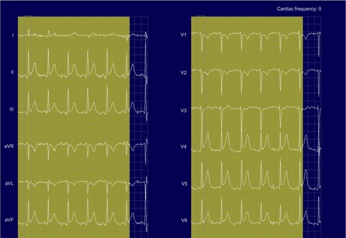 Figure 3 Second cardiac event.