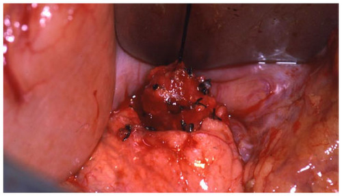 Figure 7 Enucleation of insulinoma seen in Figures 4, 5, and 6.
