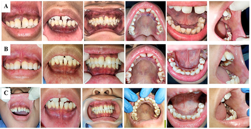 Figure 4 (A) The follow-up visit was two months from the initial visit. Gingival enlargement resolved in the anterior and posterior regions of the maxilla and mandible. (B) The follow-up visit was two weeks after the 6th visit. Gingival enlargement of all regions of the maxilla and mandible resolved, except for the palatal-anterior part of the maxilla. (C) The follow-up visit was three months of therapy after the initial visit, which showed significant improvement in the gingiva.