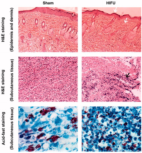 Figure 6. Subcutaneous nodules were sectioned, and stained with H&E and acid-fast. HIFU did not damage the epidermal or dermal tissues (white arrows). The black arrow indicates the central nucleus dissolution in the center of the coagulative necrotic region after HIFU ablation, with nuclear pyknosis and fragmentation in the periphery. H&E-stained images were taken at ×20 magnification, and the acid-fast staining images were taken at ×100 magnification.