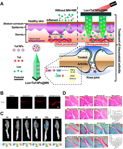 Figure 6 (A) Schematic Illustration of the Co-Delivery of Loxoprofen and Tofacitinib by Photothermal MNs for RA Treatment. (B) Visualization of RhB NPs’ permeation in the skin from different formations with CLSM in vivo. (C) In vivo images of RhB retention in the articular with the time up to 24 h after MNs administration with light irradiation. (D) Histological features of knee joint stained with HE and safranin O-fast green. (magnification 100×; scale bar: 1000 µm). (*p<0.05). Reprinted in part with permission from Lu Y, Xiao T, Lai R, et al. Co-delivery of loxoprofen and tofacitinib by photothermal microneedles for rheumatoid arthritis treatment. Pharmaceutics. 2023;15(5):1500.Citation127 Copyright 2023 MDPI.