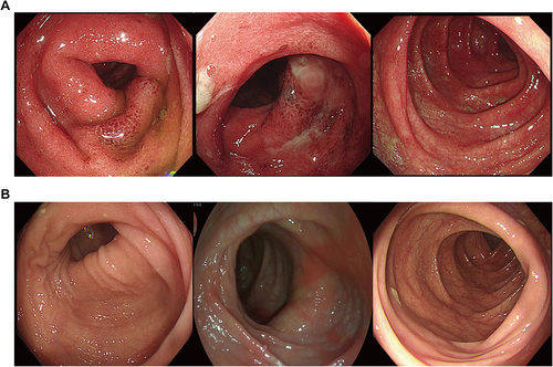 Figure 2 Typical endoscopic findings in a patient with SARS-CoV-2 Omicron variant infection. (A) Endoscopic image of the colon showing hyperemic and edematous intestinal mucosa with multiple ulcers. (B) Repeat endoscopic image one month later showing an absence of intestinal mucosal edema and healing of the ulcers. Image courtesy of the Endoscopy Center, Shanghai East Hospital, China.