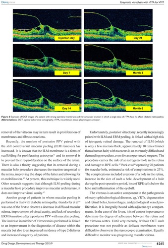 Figure 6 Examples of OCT images of a patient with strong epiretinal membrane and vitreomacular traction in which a single dose of rTPA have no effect (diabetic retinopathy).