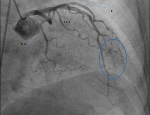 Figure 3. Coronary angiography showing multiple coronary artery microfistulae arising from first diagonal branch of LAD, emptying into the left ventricle (blue circle).