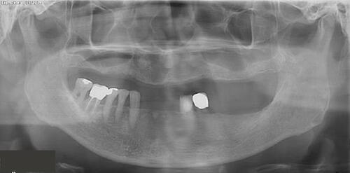 Figure 21 Orthopantogram 10 years after treatment.