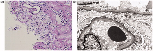 Figure 2. The light microscopic features of the renal biopsy are normal (A). Electron microscopy of glomeruli showed diffuse effacement of the podocytes (B). There is diffuse but mild thinning of the glomerular basement membranes. No immune-complex deposits are identified. The appearance is in-keeping with minimal change disease.