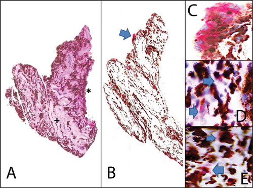 FIGURE 2. Immunohistochemistry on iris iridectomy specimens from patients with chronic CMV anterior uveitis. (A) Histology (hematoxylin and eosin stain 20×): Iris iridectomy specimen showing stroma fibrosis and atrophy (+). The posterior iris pigmented epithelium remains relatively intact (*). Viral cytopathic changes characterized by cytomegalic cells with eosinophilic nuclear and cytoplasmic inclusions are absent. Rare inflammatory cells may be seen within the stroma. (B) Low power view of CMV immunohistochemistry (20×, alkaline phosphatase red chromagen) highlights the atypical CMV antibody in occasional cells (blue arrow). (C) Higher power view of CMV immunohistochemistry (40×, alkaline phosphatase red chromagen) reveals that the CMV antibody staining is limited to the cytoplasm (blue arrows) only without the nuclear staining seen in the positive controls. (D) CD3, T-cell immunohistochemistry (40×) with alkaline phosphatase red chromagen highlights the presence of rare T cells (blue arrow). (E) CD68, macrophage immunohistochemistry (40×) with alkaline phosphatase red chromagen highlights the presence of rare macrophages (blue arrow).