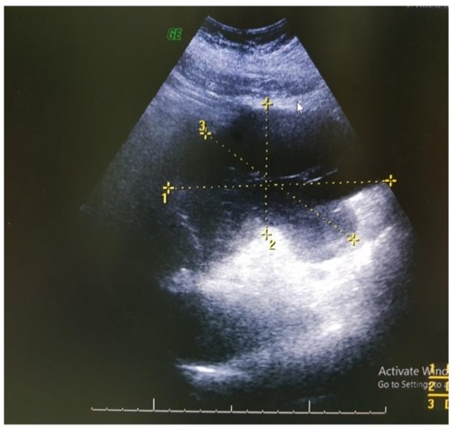 Figure 3 Collection of fluid at the epigastric area.