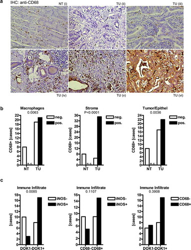 Figure 3. Correlation of DOK1 with CD68 and iNOS expression in gastric cancer. IHC on commercial TMA (US Biomax, ST483) with normal stomach (NT, n = 8) and tumor (TU, n = 40) specimens from gastric cancer patients using mouse monoclonal CD68 (AM33123SU-N) or rabbit polyclonal iNOS (PA3-030A) antibody, respectively. (a), Single CD68+ macrophages were interspersed between non-malignant gastric glands in the lamina propria (i) and with increasing frequency present (ii-vi) in tumor-adjacent stroma regions and within tumor cells (v-vi). Representative images are shown. Original magnification 200x; Scale bar = 100 µm. (b), Positivity scores for CD68 (as detailed in Figure 1) were correlated to clinical factors: tumor (TU), normal/non-tumor (NT). Data are absolute case numbers after dichotome grouping of staining as negative (scores 0/1) vs. positive (scores 2/3) (n = 48, *p < .05 TU vs. NT, Fisher Exact test; n.c. = no case recorded). Statistics is presented in Table S10. (c), Pairwise association of iNOS, CD68 and DOK1 positivity scores in immune infiltrates of tumor tissue. Data are absolute case numbers after dichotome grouping of stainings as negative (scores 0/1) vs. positive (scores 2/3) (TU only; n = 40, *p < .05, Fisher Exact test). Statistics for iNOS is presented in Table S11.