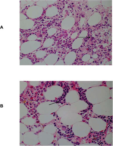 Figure 4 Bone marrow responses to 5-Azacytidine.The bone marrow trephine biopsies from a patient with monosomy 7 were stained with hamatoxylin and eosin.(A) prior to 5-Azacytidine, showing a normocellular marrow with dysplastic megakaryocytes (arrow) and no erythropoiesis. (B) Post 5-Azacytidine in cytogenetic remission the bone marrow was normocellular and erythroid islands (arrow) were present. Marked eosinophilia post Azacytidine is evident.