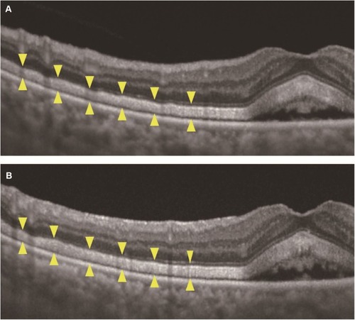 Figure 3 High magnification SS-OCT images at the parafoveal area of the right (A) and left (B) eyes at the initial visit. In both the area where the SRD appeared and in the adjacent area, SS-OCT detected a high reflection of the photoreceptor outer segment while the interdigitation zone was indistinguishable (between the arrowheads). SS-OCT also detected thickening (maximum diameter 75 μm) of the photoreceptor outer segment. The reflection of the retinal pigment epithelium line appeared to be brighter with slightly poorer margins.