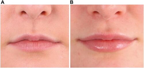 Figure 18 Before (A) and after (B) photos of lip contouring. Patient also received lip volumizing. Courtesy Dr. Jani van Loghem.