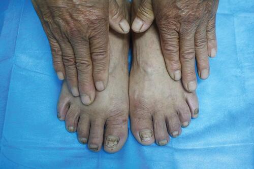 Figure 3 A month later, clinical photograph showing scattered lightened brown pigmentation on the toenails.