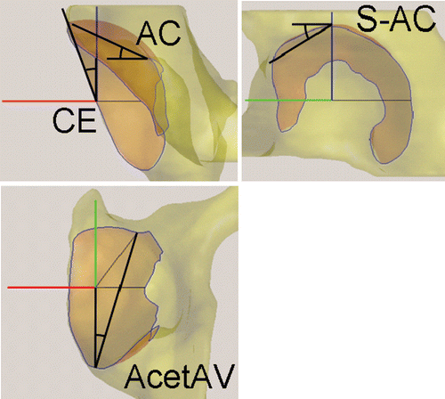 Figure 3. Transparent views of the acetabulum. The 3D Lunate-Trace curve is shown as a blue outline, and the region in red is the interpolated surface of the acetabulum lunate. The angles are defined using the segmented model, and are analogous to those in Figure 1. [Color version available online.]