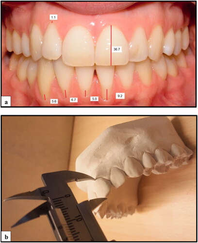 Figure 1. (a) Intraoral photographs of the anterior segment measured (mm) with Planmeca Romexis®; and (b) study casts measured (mm) with Vernier calliper.