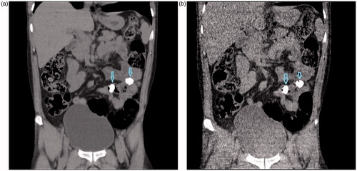 Figure 1. Reformatted coronal non-contrast abdominopelvic CT images of a 33-year-old man with the history of package ingestion, who underwent both CT protocols: Standard dose CT, (a) and low dose (b) represent two drug baggies (arrows) within small bowel loops.