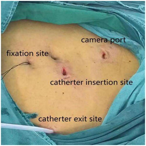 Figure 5. External view of Tenckhoff catheter placement (The right side is the head).