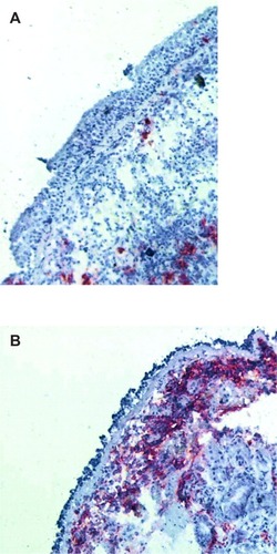 Figure 2 (A) A normal bronchial biopsy from a patient without asthma compared with (B) a bronchial biopsy specimen from a patient with a history of asthma but in complete remission demonstrates epithelial shedding and extensive presence of α-major basic protein.