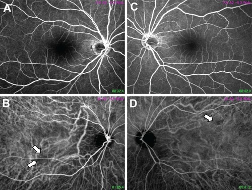 Figure 1 Fundus photographs of fluorescein angiography (A and C) and indocyanine green angiography (B and D) of case 1. Although no abnormality was observed in either eye by fluorescein angiography ((A) right eye, (C) left eye), several hypofluorescent regions were observed by indocyanine green angiography (arrows in (B and D), (B): right eye, (D): left eye).