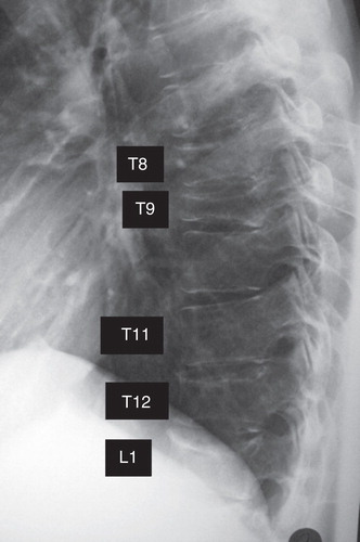 Figure 1. Lateral radiograph of the vertebrae in case 2. Radiograph showed mild compression changes at the 8th, 9th, and 12th thoracic vertebrae and 1st lumbar vertebra.