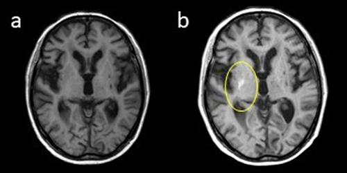 Figure 1 Magnetic resonance imaging (MRI) on the day of examination (a) and 14 days later (b).