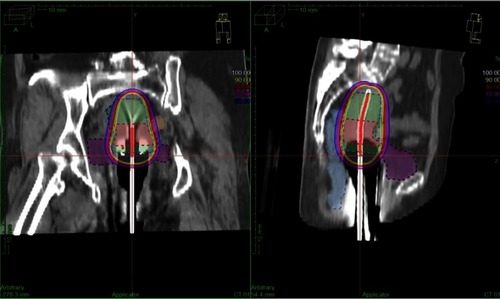 Figure 2 Computed tomography image showing isodose curves during intracavitary brachytherapy of a cervical cancer patient.