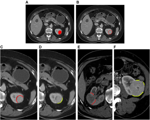 Figure 1 (A) showed the VOI of tumor. (B) was the VOI of mini-peritumor, which automatically expanded 2-mm from the margin of the lesion with “A.K.” software. (C and D) was the manually divided Pr/Pf-VOI based on the mini-peritumoral VOI. (E) demonstrated that the Pr-VOI did not include blood vessels and fat in renal hilar region. (F) illustrated that if the Pf-VOI affected by the surrounding structures (such as intestine, liver, adjacent muscle, and so on), this portion was manually removed.