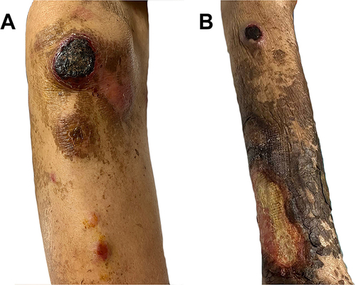Figure 2 New round erythematous plaque on her right leg (A) and nodule on the left leg (B), measuring 2–3 cm in diameter with ulceration and central necrotic crust. The preexisting granulomatous mycosis fungoides shows large ulcerative brownish plaque on the distal leg (B).