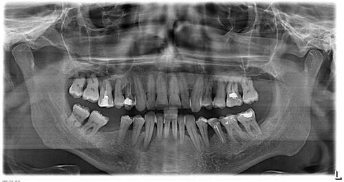 Figure 6 Panoramic radiograph 6 months after SRP: tooth #43 showed an extensive periapical lesion with well-defined borders and bone loss extruding onto the root’s mesial surface.