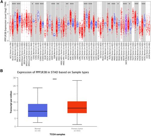 Figure 1 PPP1R3B was overexpressed in STAD tissues.