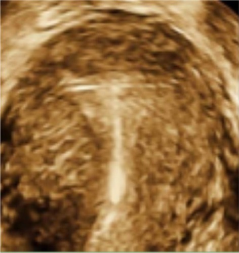 Figure 7 T-shaped Femilis® levonorgestrel intrauterine system (Contrel Europe NV, Ghent, Belgium) with transverse arm of either 24 mm or 28 mm, showing perfect fit in the fundus of the uterus.
