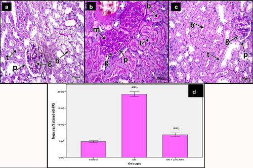 Figure 6. Periodic acid Schiff-stained sections of the renal cortex of the study groups. a Control group, showing reaction in the basement membrane (arrow) of tubular epithelium (t), glomerular capillaries (g) and along with the parietal epithelial cells of Bowman’s space (p). The reaction also appears in the brush borders of the renal tubules (b). b DN group, showing increased reaction in the basement membrane (arrow) of tubular epithelium (t), glomerular capillaries (g) and along with the parietal epithelial cells of Bowman’s space (p) in addition to increased mesangium (m). The reaction is increased in the brush borders of the renal tubules (b). c DN + ZnO-NPs, showing nearly normal reaction in the basement membrane (arrow) of tubular epithelium (t), glomerular capillaries (g) and along with the parietal epithelial cells of Bowman’s space (p). The reaction also appears in the brush borders of the renal tubules (b). d The mean area % of positive reactions in PAS-stained sections, values are displayed as mean ± standard errors (X ± SEM); a: P compared to control group; b: P compared to DN group; #: P< .05; ##: P< .001.