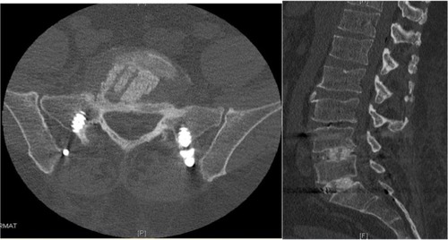 Figure 10 CT scan of the L5-S1 disk space showing complete filling of the prepared disk space and successful fusion and incorporation of bone graft 15 months postfusion.