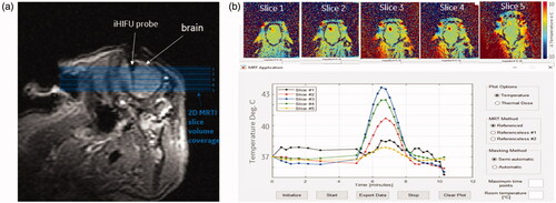 Figure 3. MRTI temperature maps from one acute swine (a) MRI image showing probe location after insertion into swine’s brain. Orthogonal, contiguous MRTI slice placement is shown with shaded blue background indicating the volume of tissue being imaged. (b, top) MRTI maps for slices labeled in (a) set to the maximum heating timepoint. (b, bottom) Improved MRTI software user interface with real-time average temperature plot for a user-drawn ROI in MRTI map.
