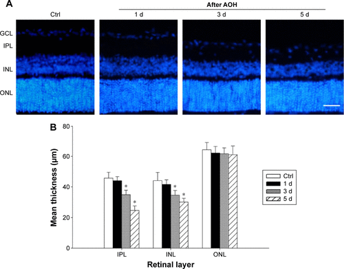 Figure S1 (A) Reprehensive results of Hoechst staining in rat retina after 1 d, 3 d, and 5 d of AOH; (B) Quantitative analysis of the retinal thickness.