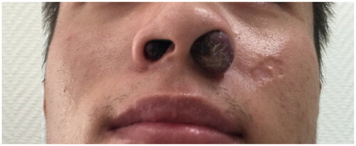 Figure 1. An examination showed a red bulging nodule out of the left nostril without surface hemorrhage or breakage; a smaller nodule on his right nostril.