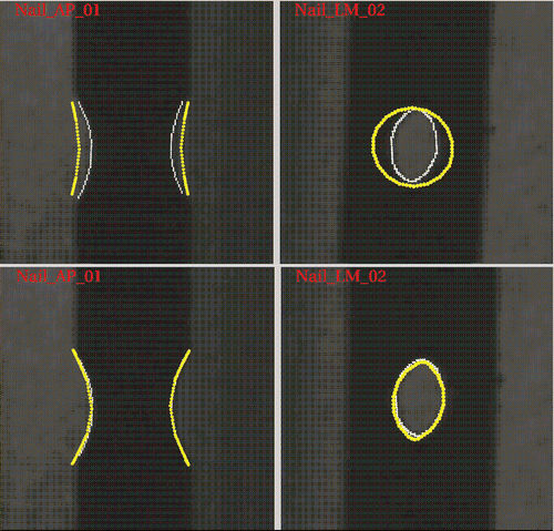 Figure 5. Example of pose recovery of a DLH by fitting its geometric model to the images. Top: The initial situation, where the thin white points are the detected DLH edge pixels and the thicker yellow points are the simulated X-ray projections of the DLH model. Bottom: The situation after the algorithm converges to the optimal solution. [Color version available online.]