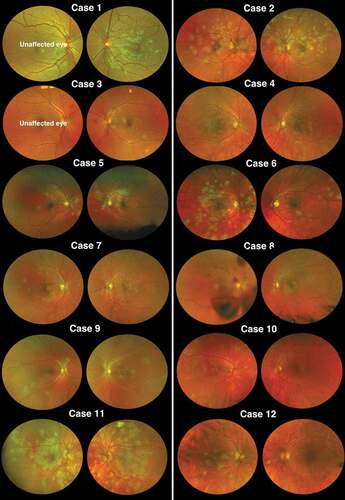 Figure 1. Posterior pole scanning laser ophthalmoscopy appearance. Cases 1–12 at the time of acute lesions for each eye or at the earliest presentation.